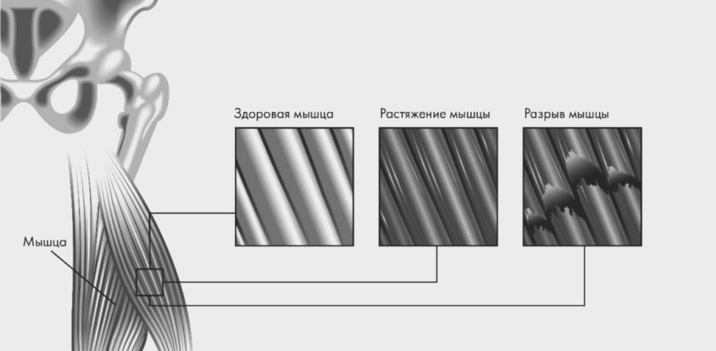 Растяжение мышц бедра лечение
