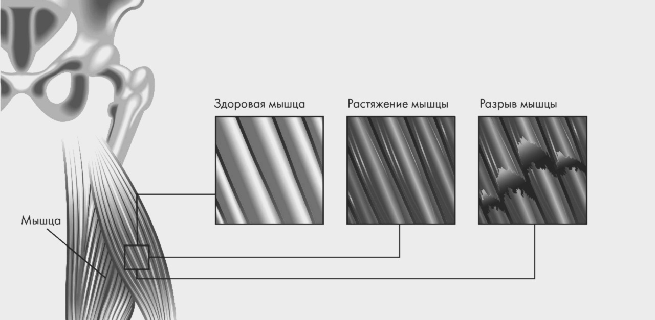 Растяжение мышц бедра лечение консервативными методами