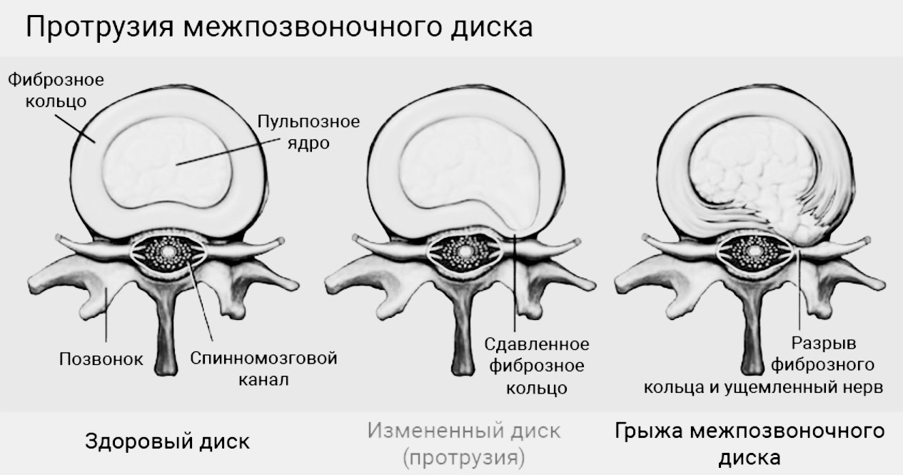 Протрузия